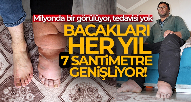 Bacakları her yıl 7 santimetre genişliyor