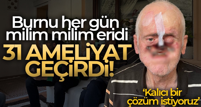 Burnu her gün milim milim eridi, 31 ameliyat geçirdi