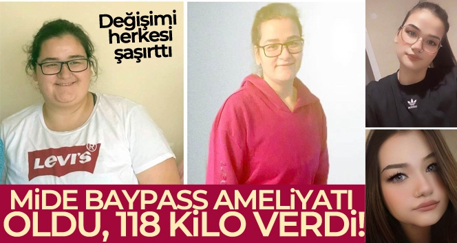 Mide baypass ameliyatı oldu, 177 kilodan 59 kiloya düştü